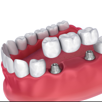 Dental Bridges