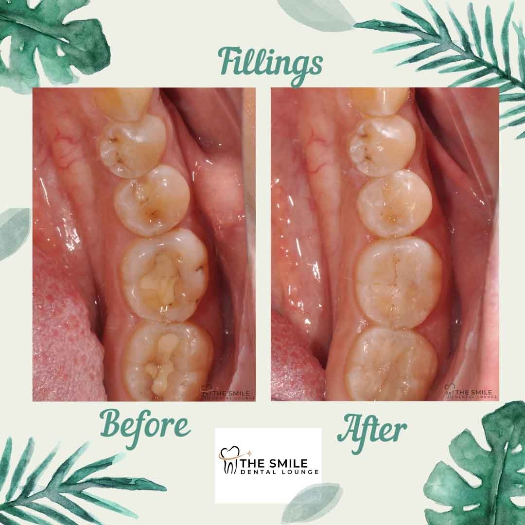 Dental Filling
