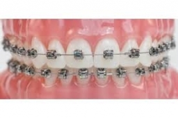 Traditional Metal Wire Braces 2018-02-11