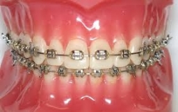 Traditional Metal Wire Braces 2018-02-11
